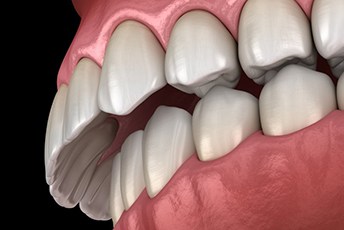 Illustration of overbite?