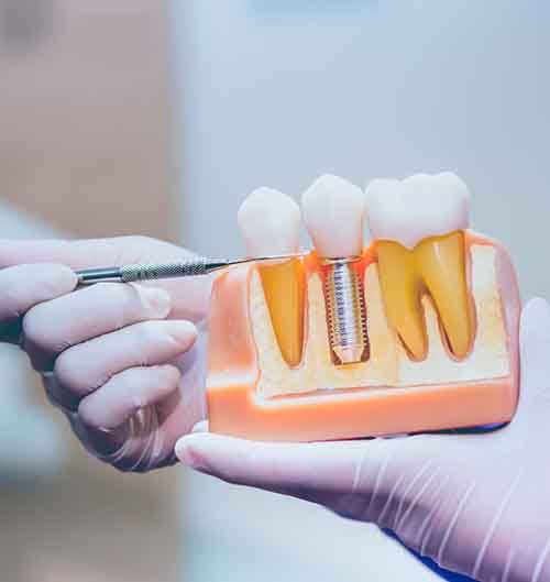 Dentist pointing to a dental implant model