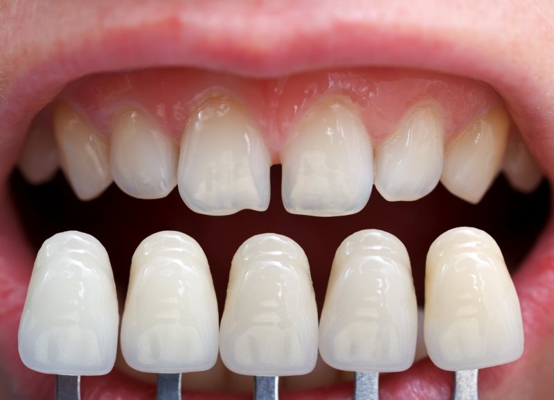 dentist holding different types of veneers up to patients’ teeth